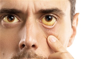 ما هي الأسباب الكامنة وراء الاصفرار داخل العين؟