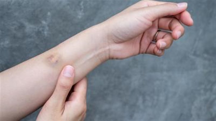 ظهور الكدمات في الجسم