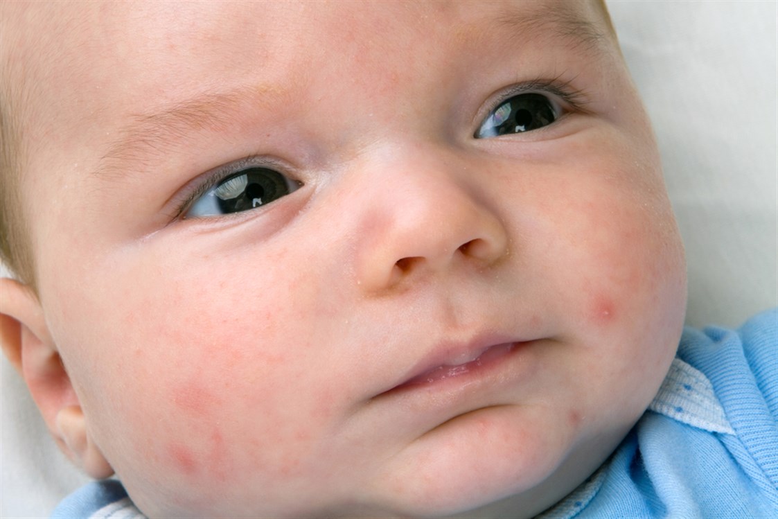  حساسية الوجه لدى الرضع