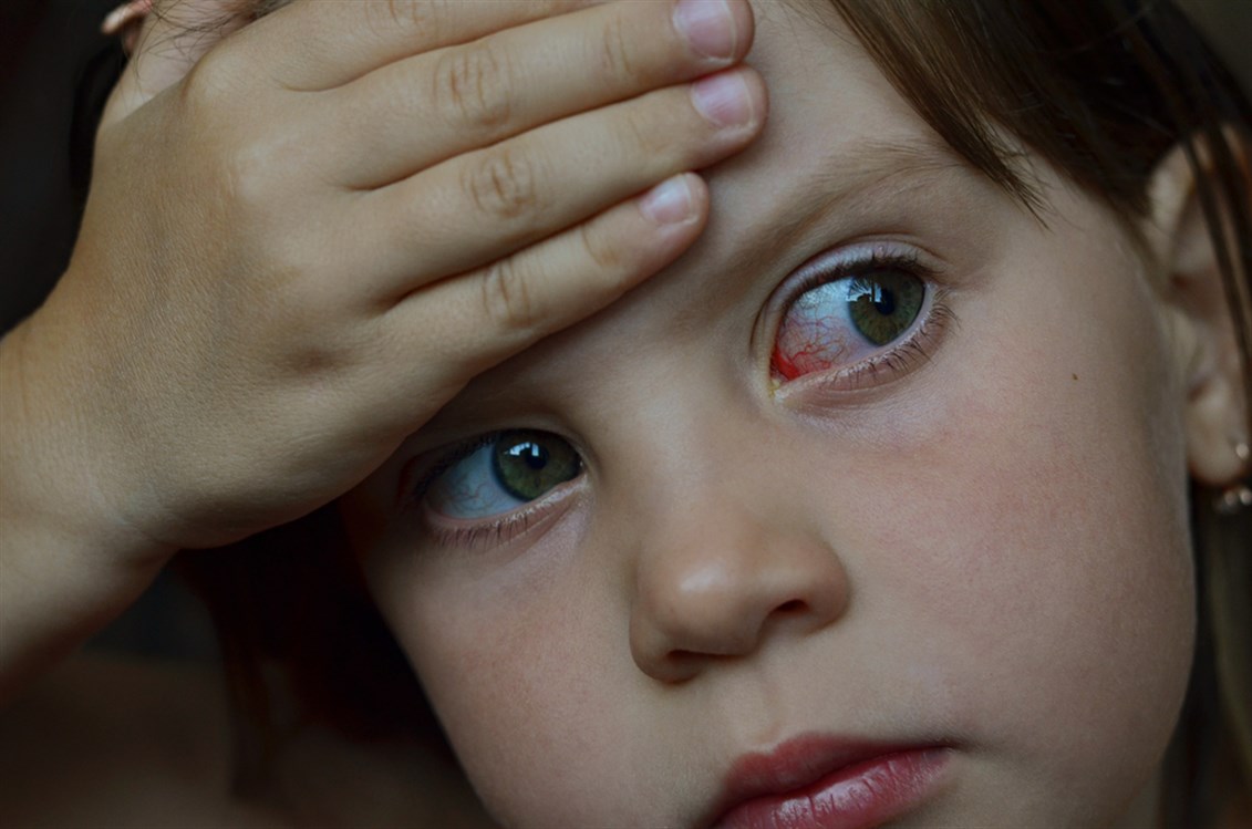  احمرار العيون عند الأطفال