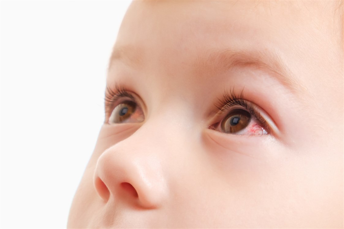 احمرار العين عند الطفل