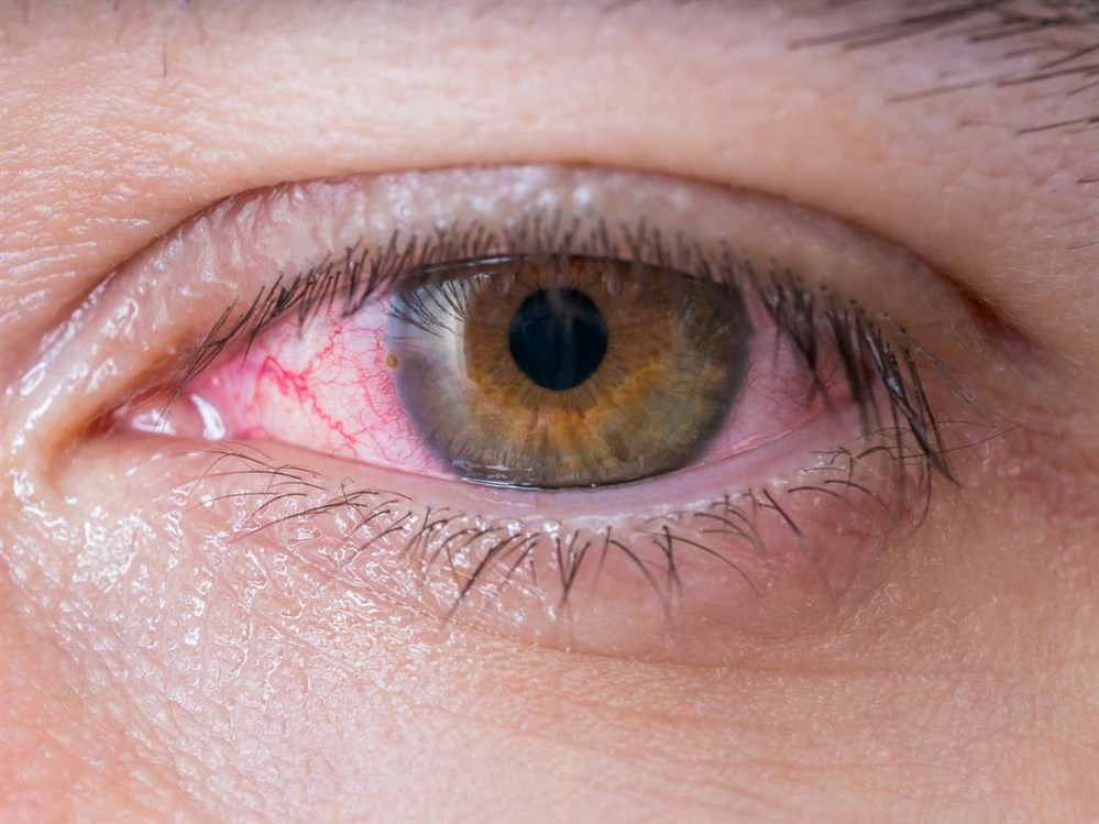علاج فيروس العين