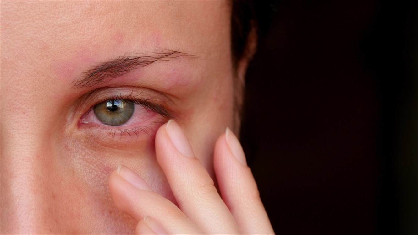 هل فيروس كورونا يسبب التهاب العين