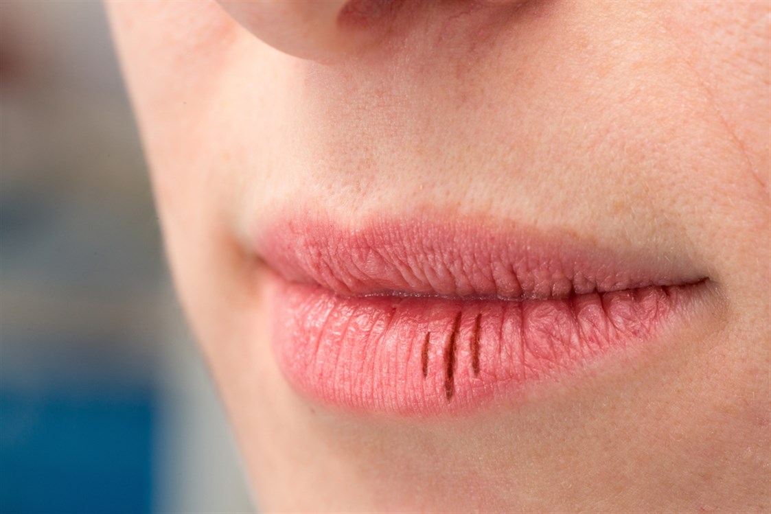  هل جفاف الفم من علامات فيروس كورونا