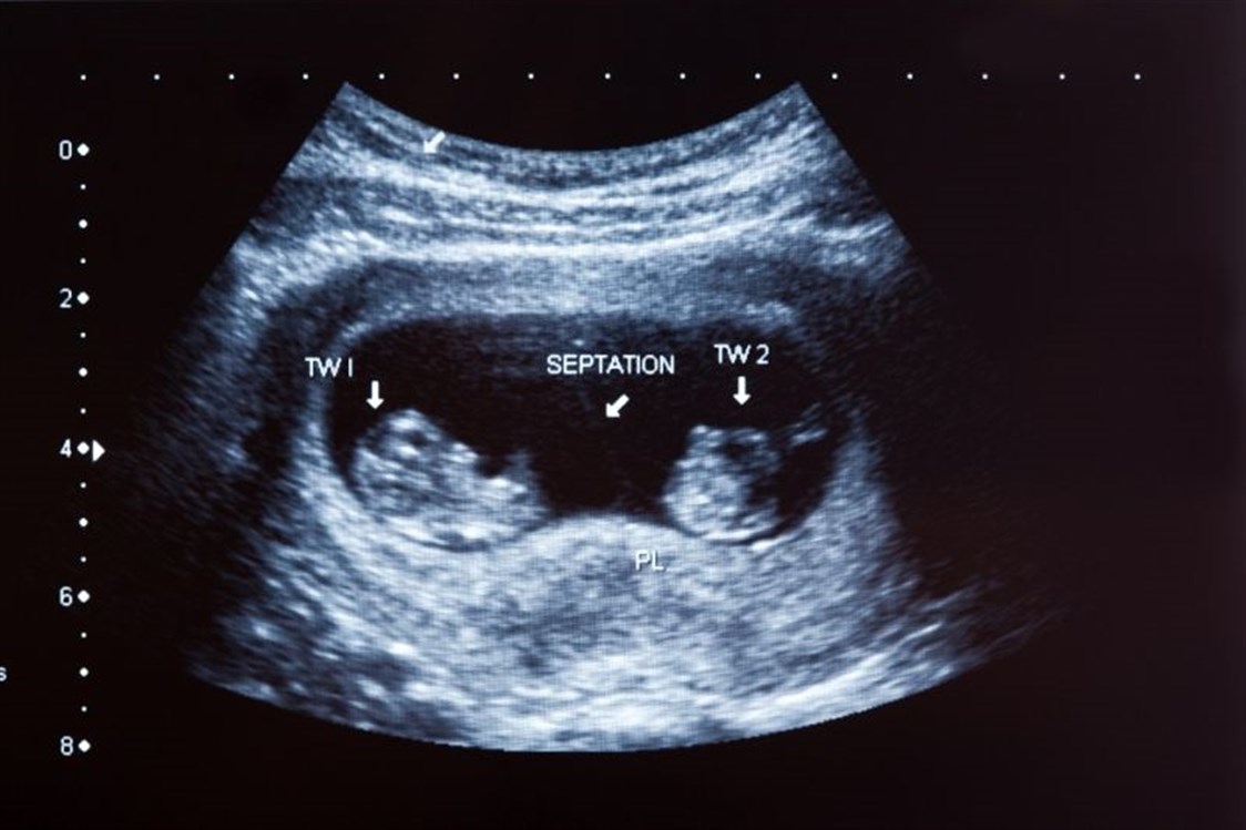 مراحل نمو الجنين سونار توأم في الشهر الاول songsay
