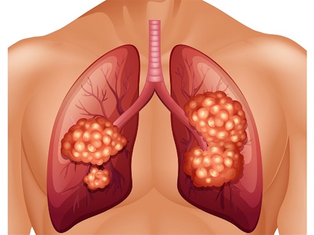 Туберкулез последняя стадия. Раковая опухоль легких фото. Рак 4 стадии без лечения