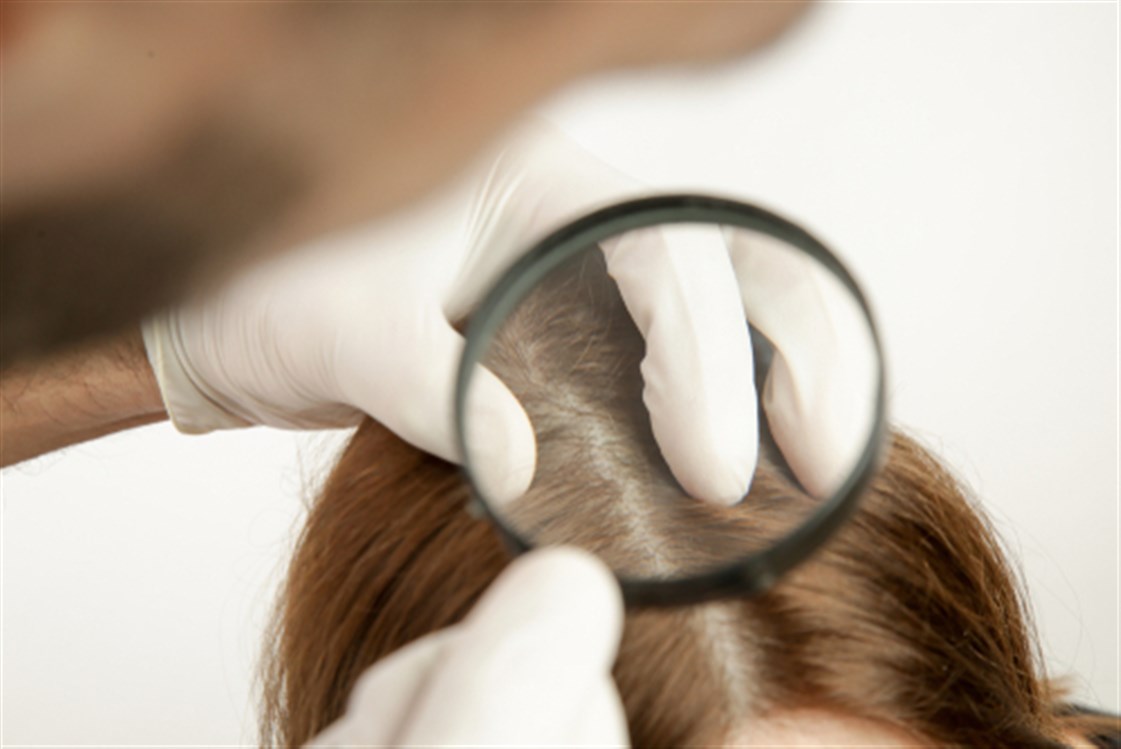 علاج اكزيما الشعر 