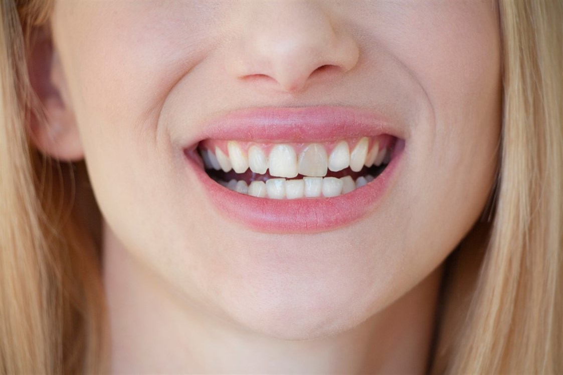 البقع البنية على الأسنان