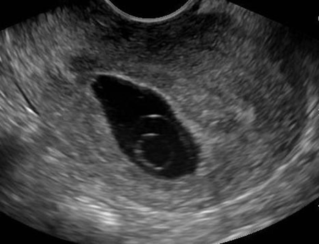 Неразвивающаяся беременность код. Анэмбриония – замершая беременность. Анэмбриония 7 недель беременности. Анэмбриония на УЗИ 6 недель.