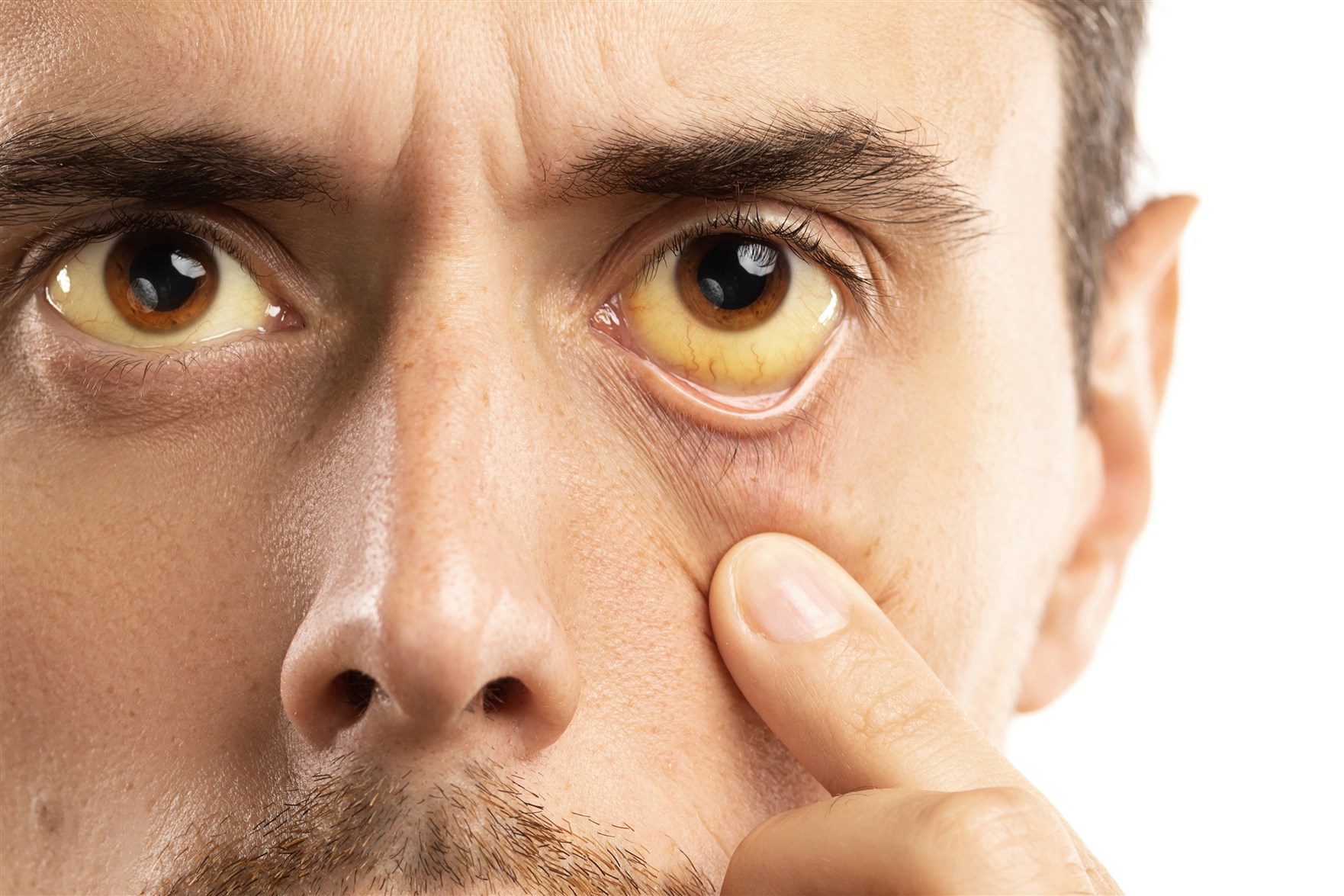 ما هي الأسباب الكامنة وراء الاصفرار داخل العين؟